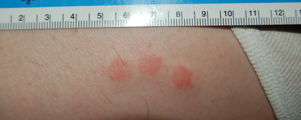 3 bb impact sites